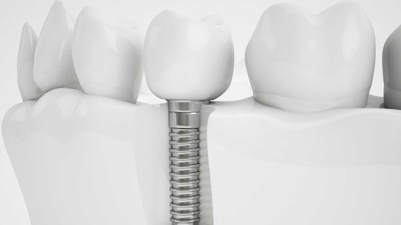 dis-implantlari-ile-gelen-yeni-hayat