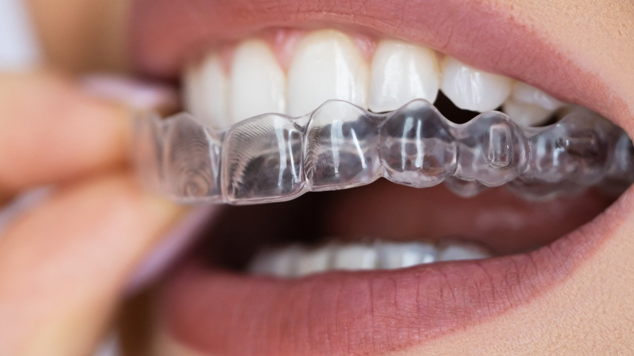 seffaf-plak-tedavisi-hakkinda-sorulan-sorular