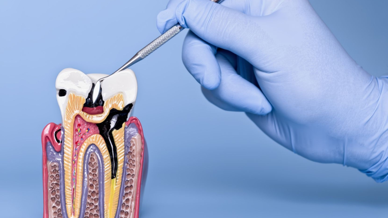 dis-curuklerinden-korunmak-icin-neler-yapilmali