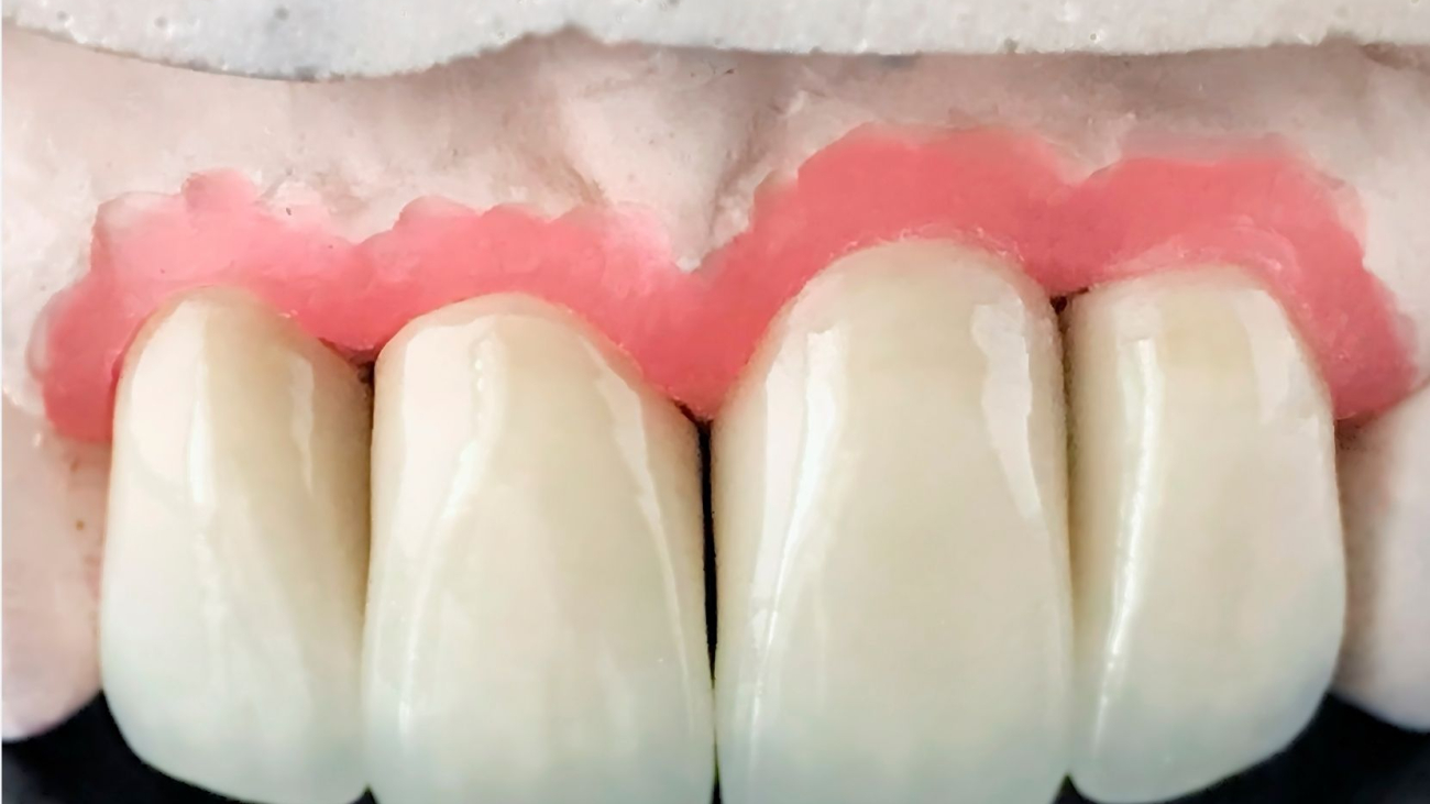 dis-eti-cekilmesi-geri-dondurulebilir-mi-1